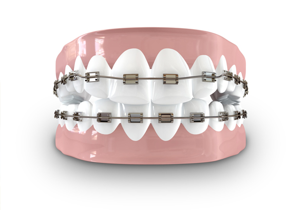 Brackets Orthodontics Dental